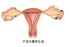 子宫内膜异位症的形成原因