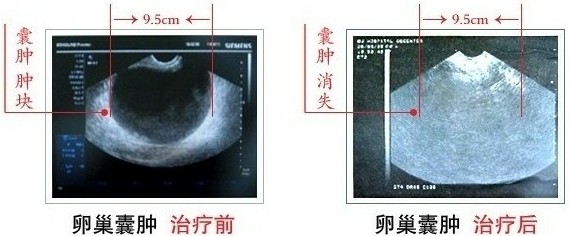 卵巢囊肿